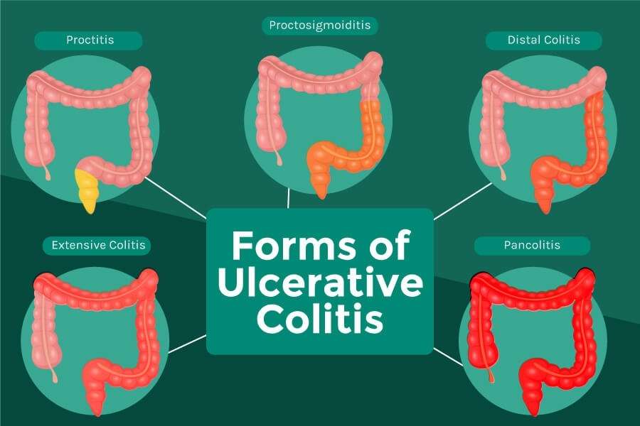 Ulcerative Colitis treatment in Ayurveda