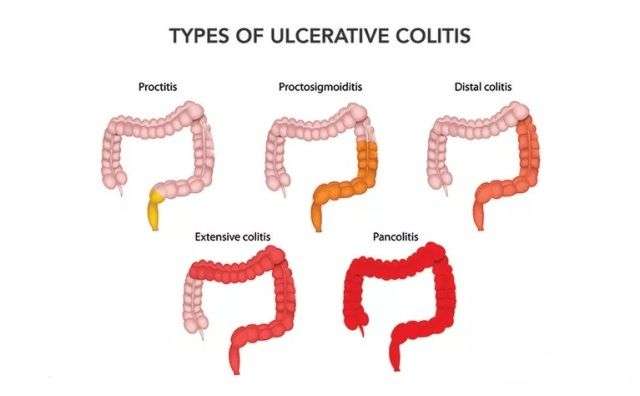Ulcerative Colitis: Types, Symptoms, and Causes ...