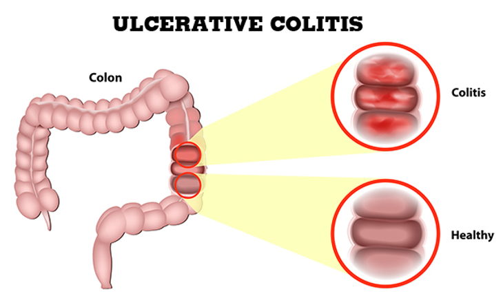 Ulcerative Colitis: Warning Signs, Diagnosis, Treatment and Remission ...
