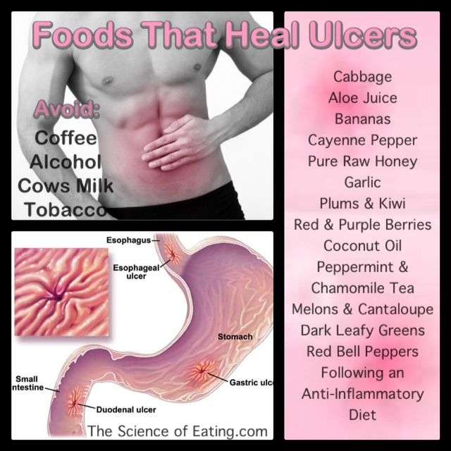 Ulcers are painful, open sores that develop on the lining of the ...