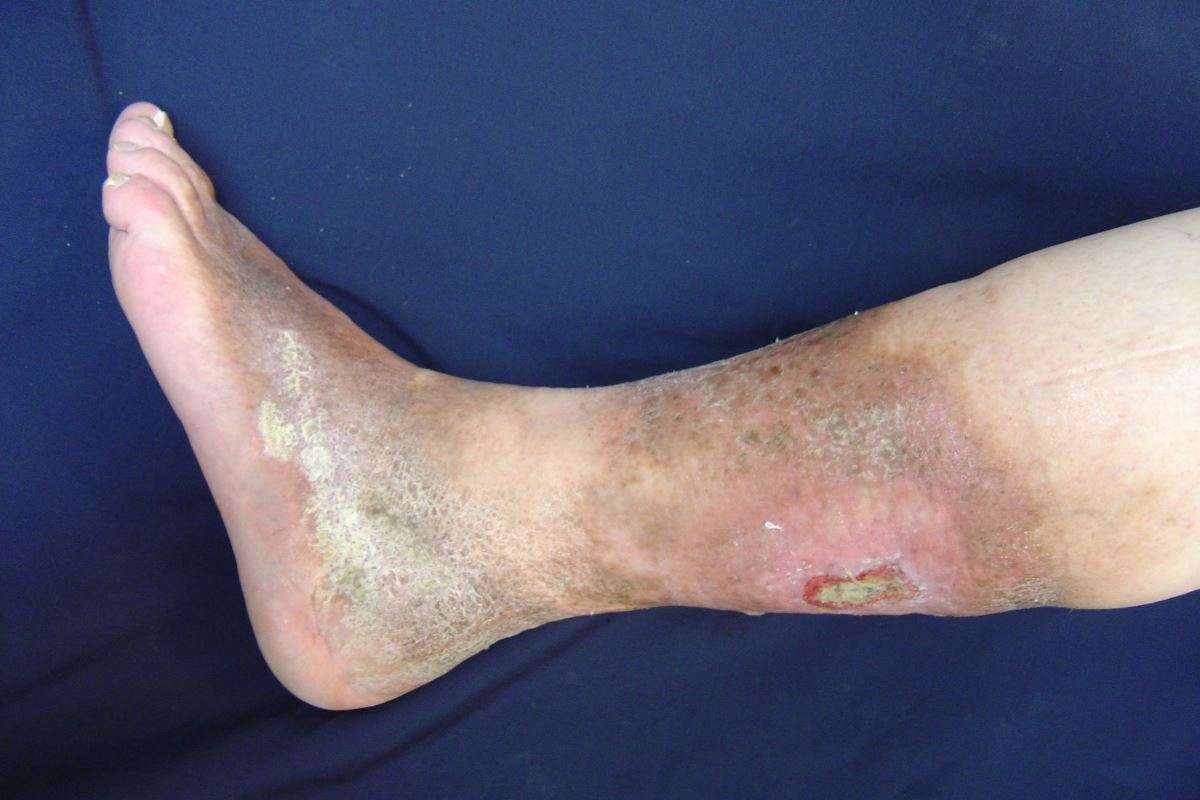 Venous insufficiency ulcer pictures