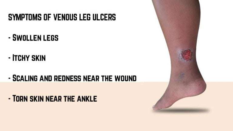 Venous Leg Ulcer: Symptoms, Causes, and Prevention