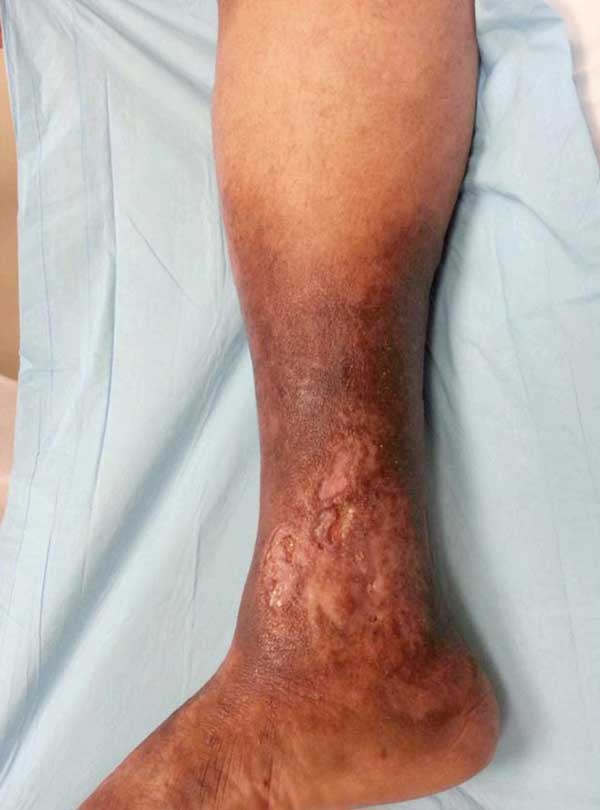 Venous Stasis Ulcers