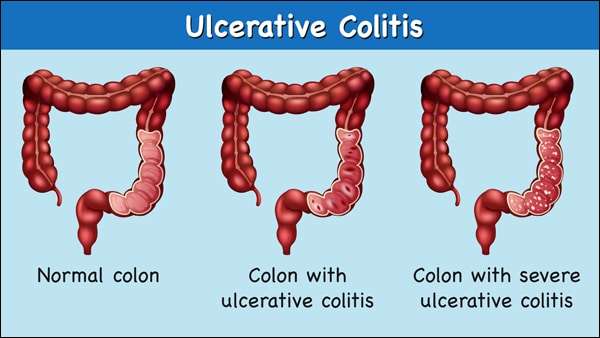 What Ayurveda Says about Ulcerative Colitis?