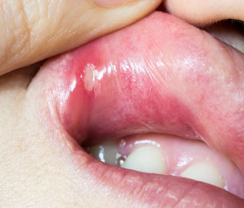 What causes mouth ulcers and how to treat them with stuff ...