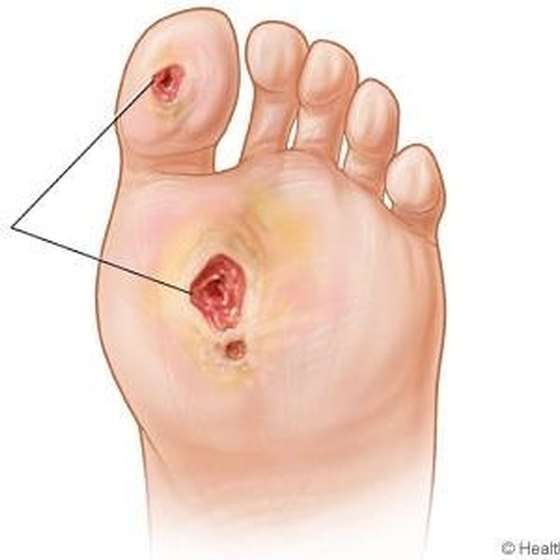 What Does a Foot Ulcer Look Like?