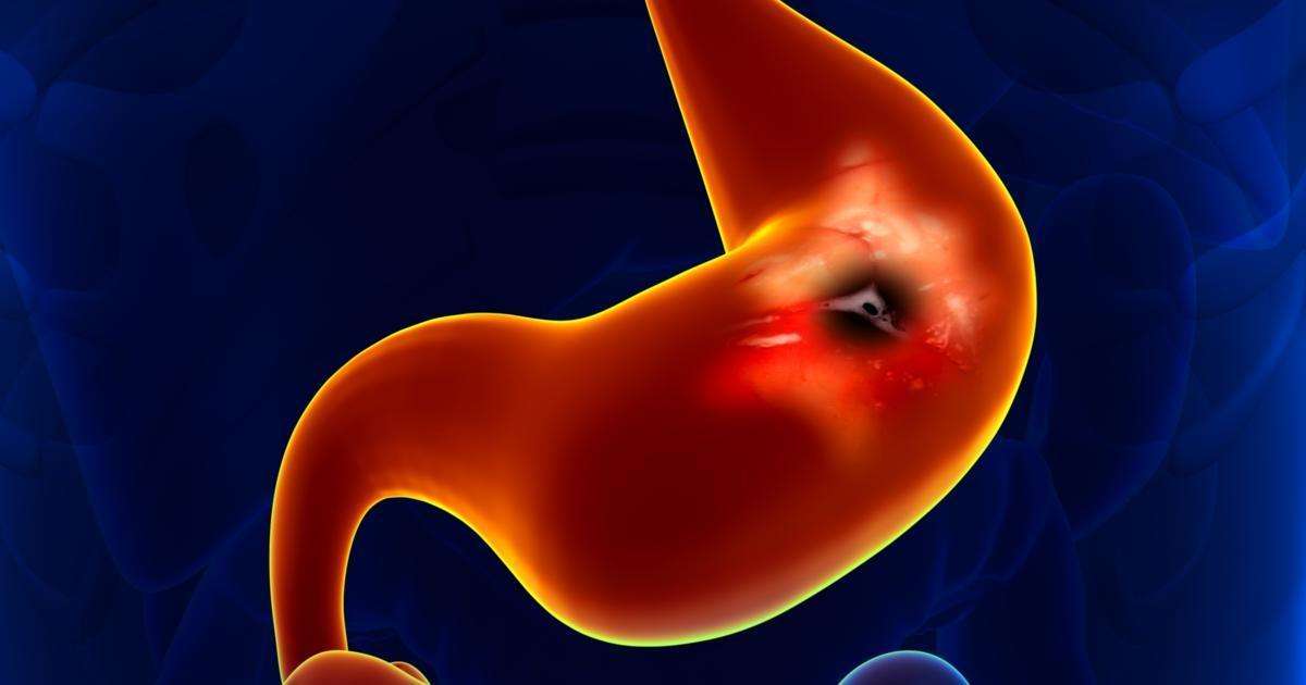 What Does a Stomach Ulcer Look Like?