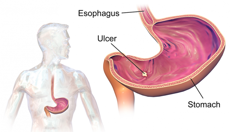 What Does An Ulcer Feel Like After Gastric Bypass