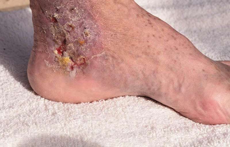 What is a Diabetic Foot Ulcer and How to Fix them!