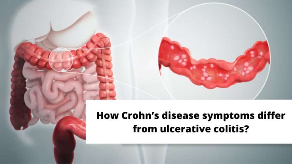 What is Crohns disease? Causes and Symptoms and Risk Factors