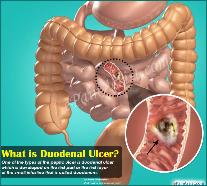 What is Duodenal Ulcer