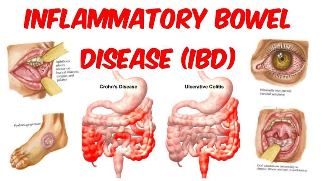 What is Inflammatory Bowel Disease (IBD)