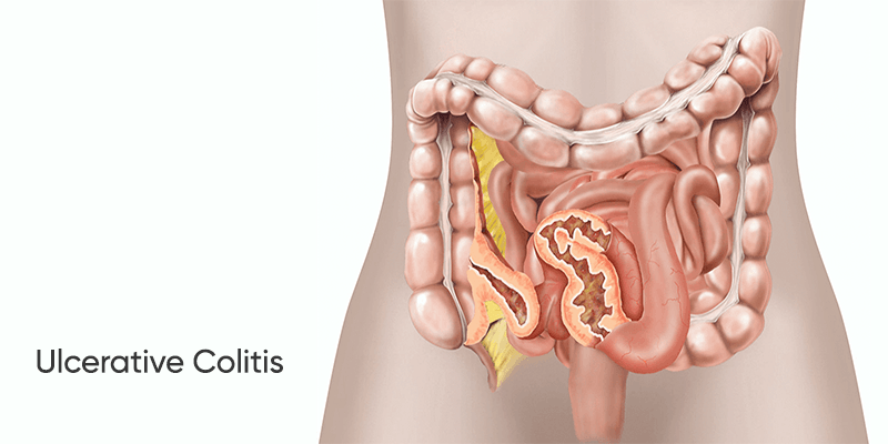 What is Ulcerative Colitis (UC)?
