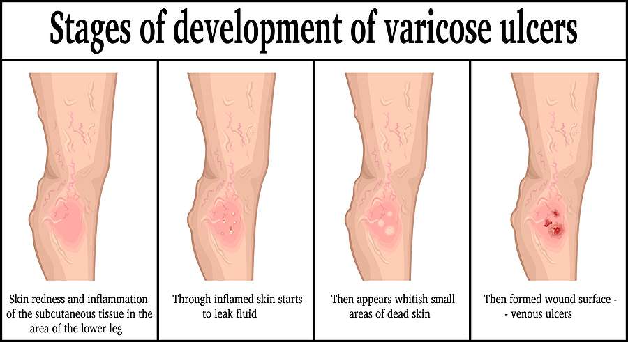 what you need to know about venous stasis ulcers west florida vein