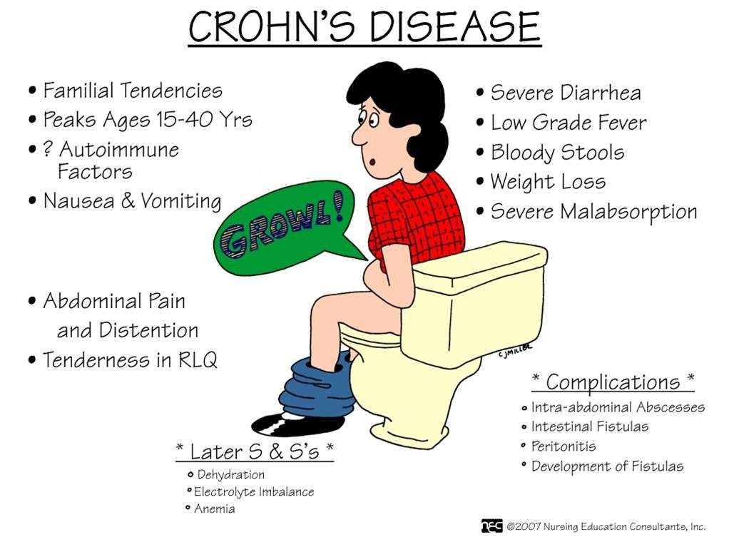 What you Should know about Crohns disease