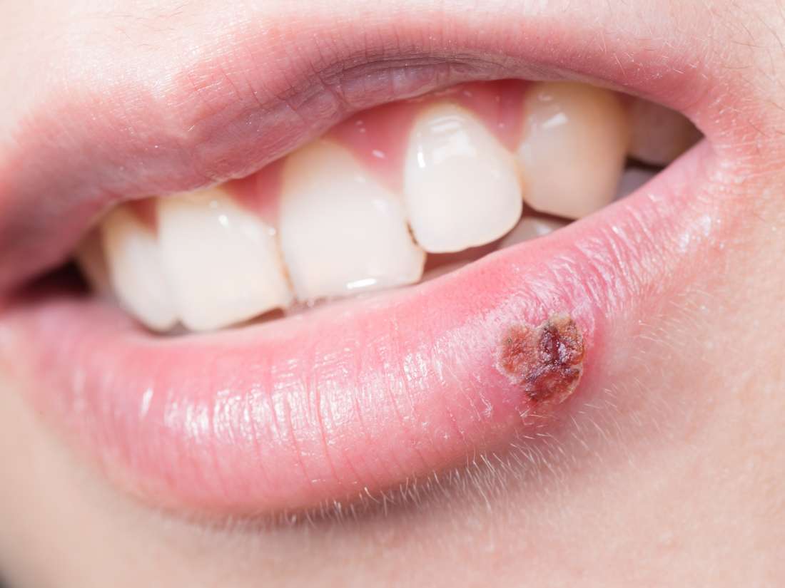 Why do I keep getting cold sores? Causes and prevention