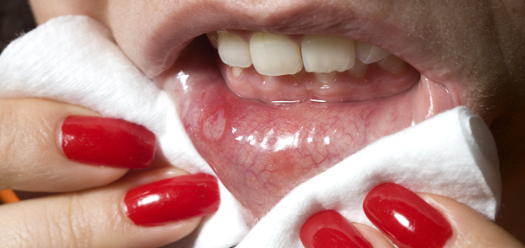 Why you keep getting Mouth Ulcers