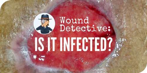 Wound Detective Series: Is It (Or Is It Not) Infected?